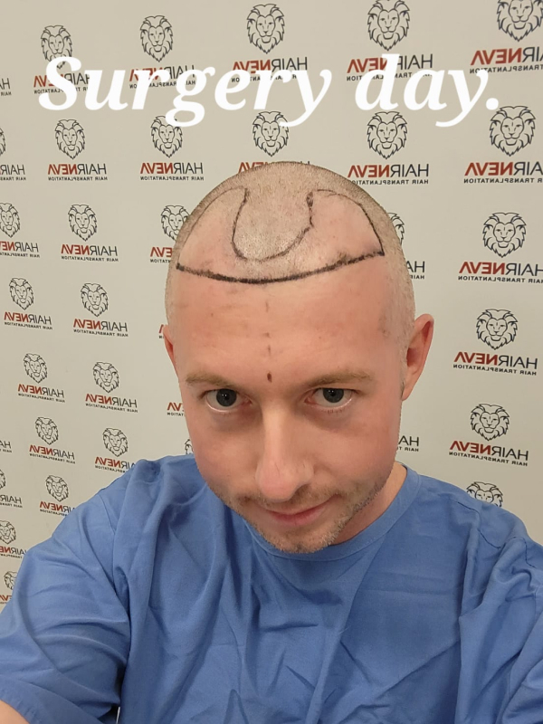 Hair Transplant Surgery Day