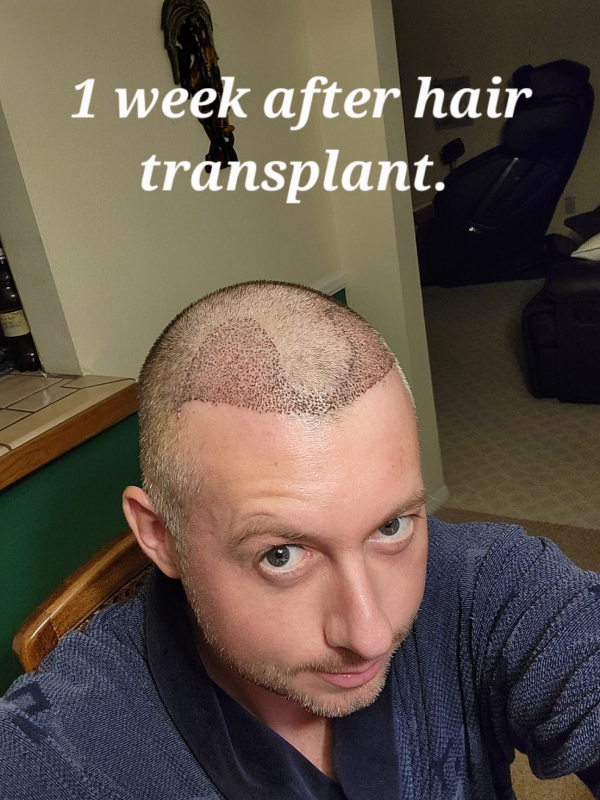 Hair Transplant After 1 Week