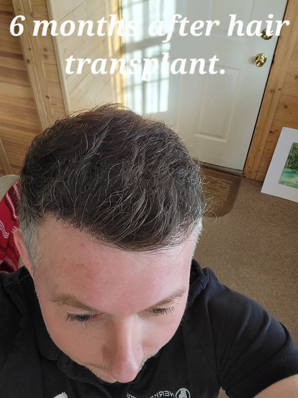 Hair Transplant After 6 Month