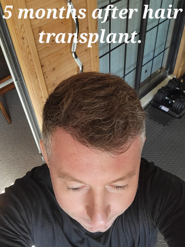 Hair Transplant After 5 Month