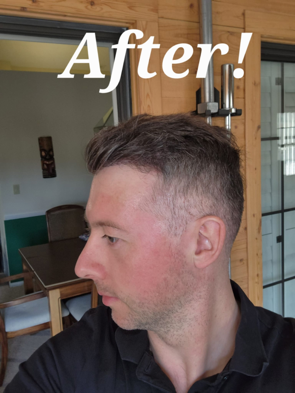 Hair Transplant After