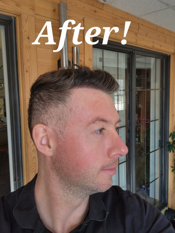 Hair Transplant After