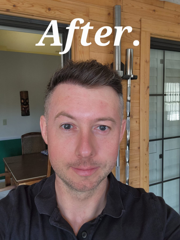 Hair Transplant After