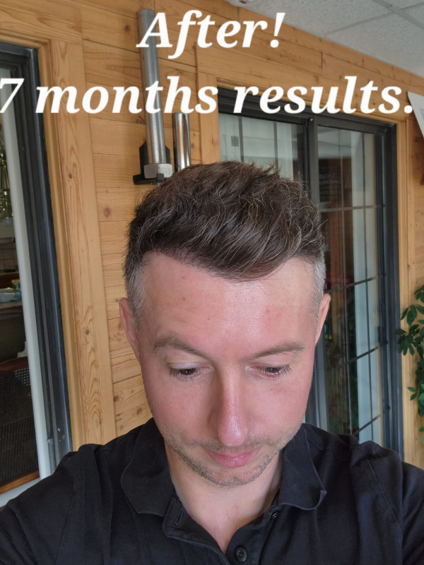 Hair Transplant Istanbul After 7 month