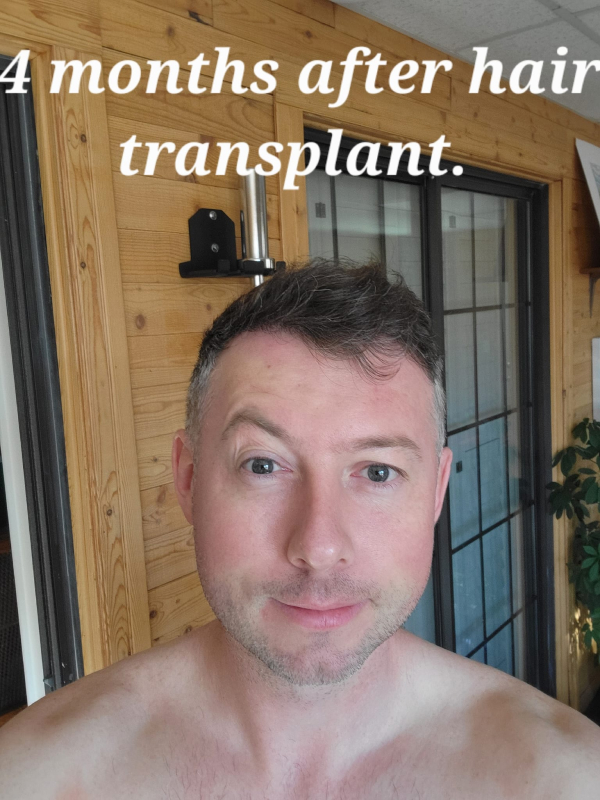 Hair Transplant Istanbul After 4 month