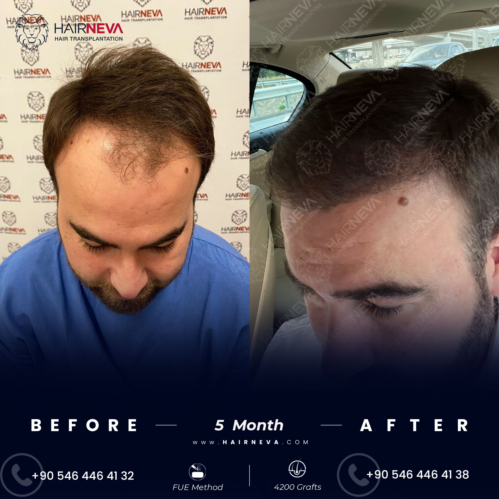 Before & After Hair Transplant