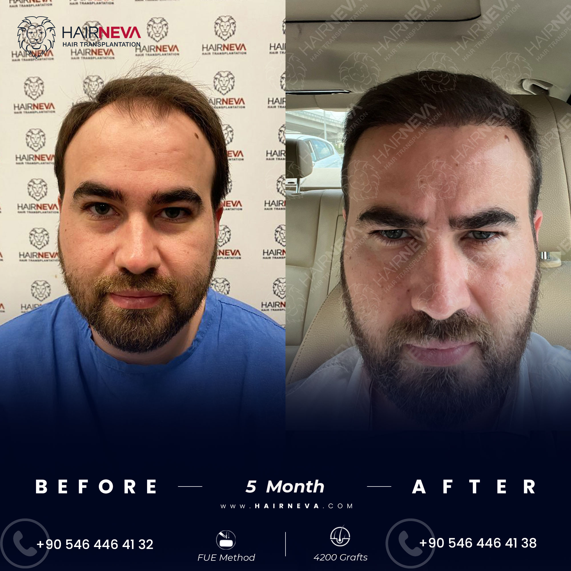 Before & After Hair Transplant Turkey