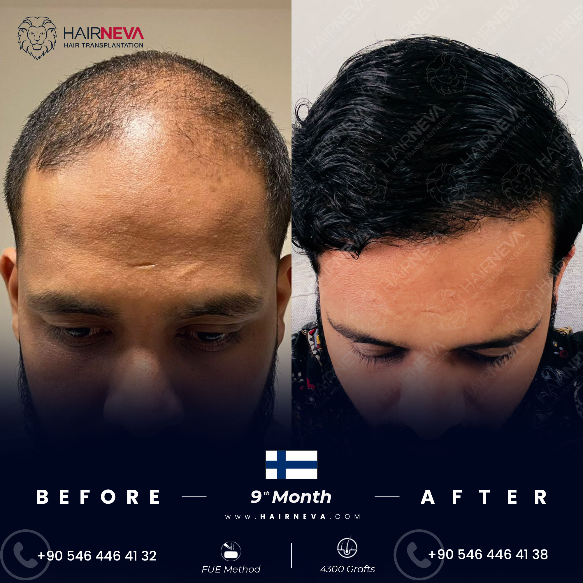 FUE Hair Transplant Turkey Istanbul