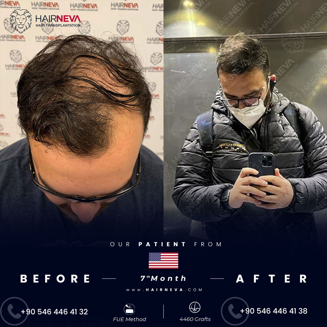 FUE Hair Transplant