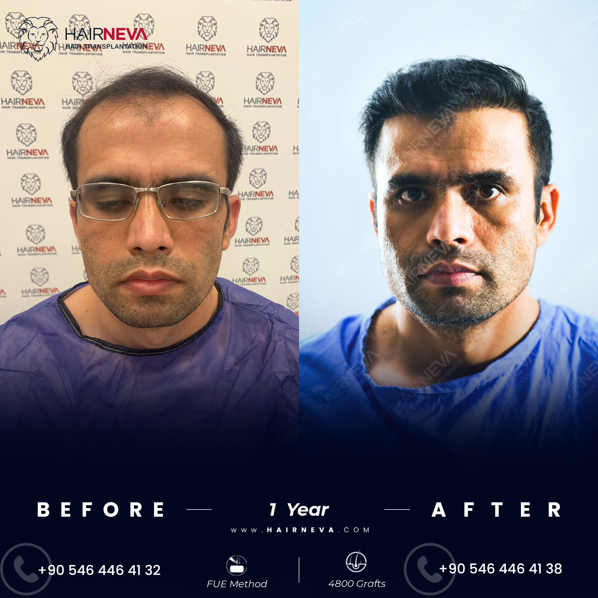 Hair Transplant Before & After