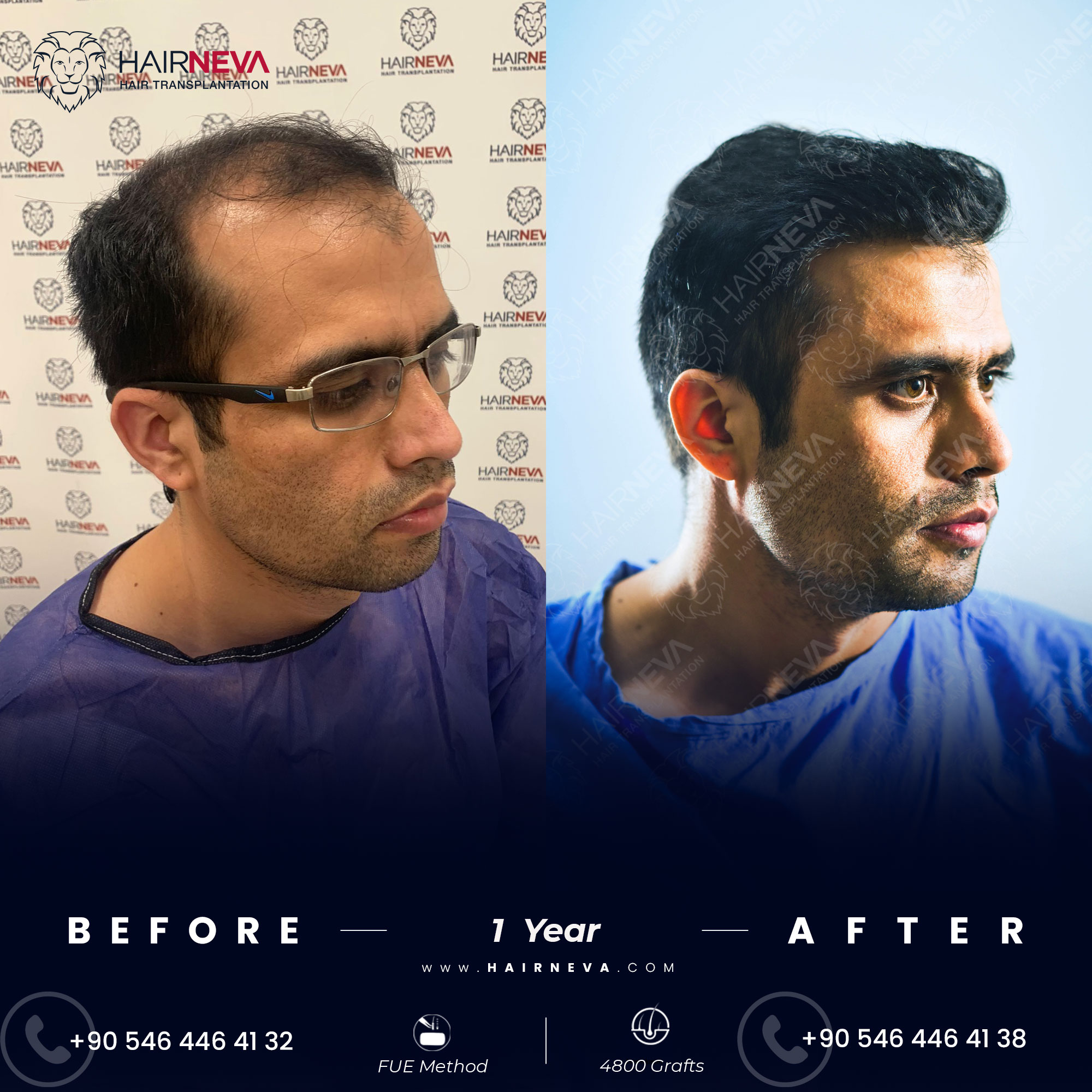 Hair Transplant Before & After Results Turkey