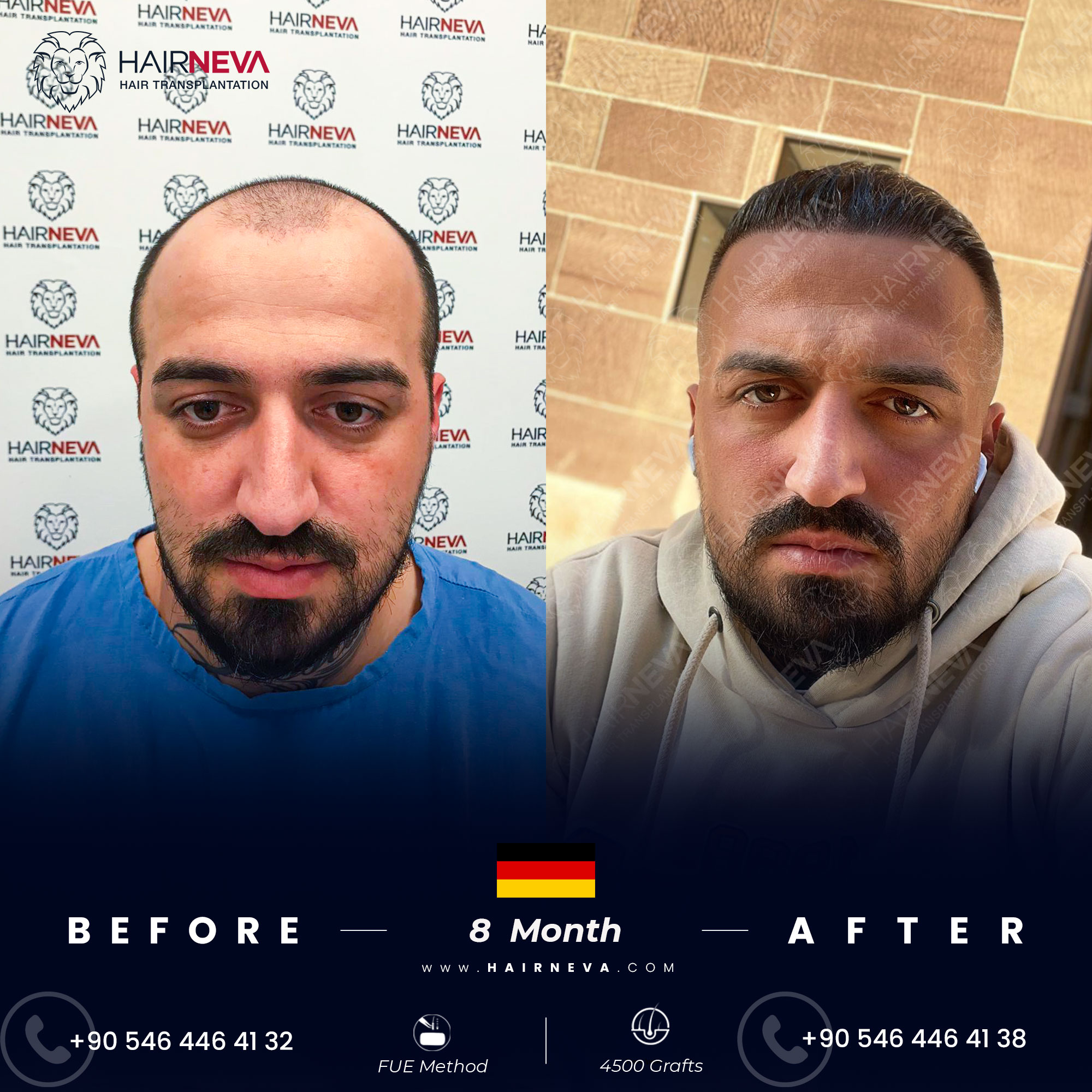 Cost Hair Transplant Before After