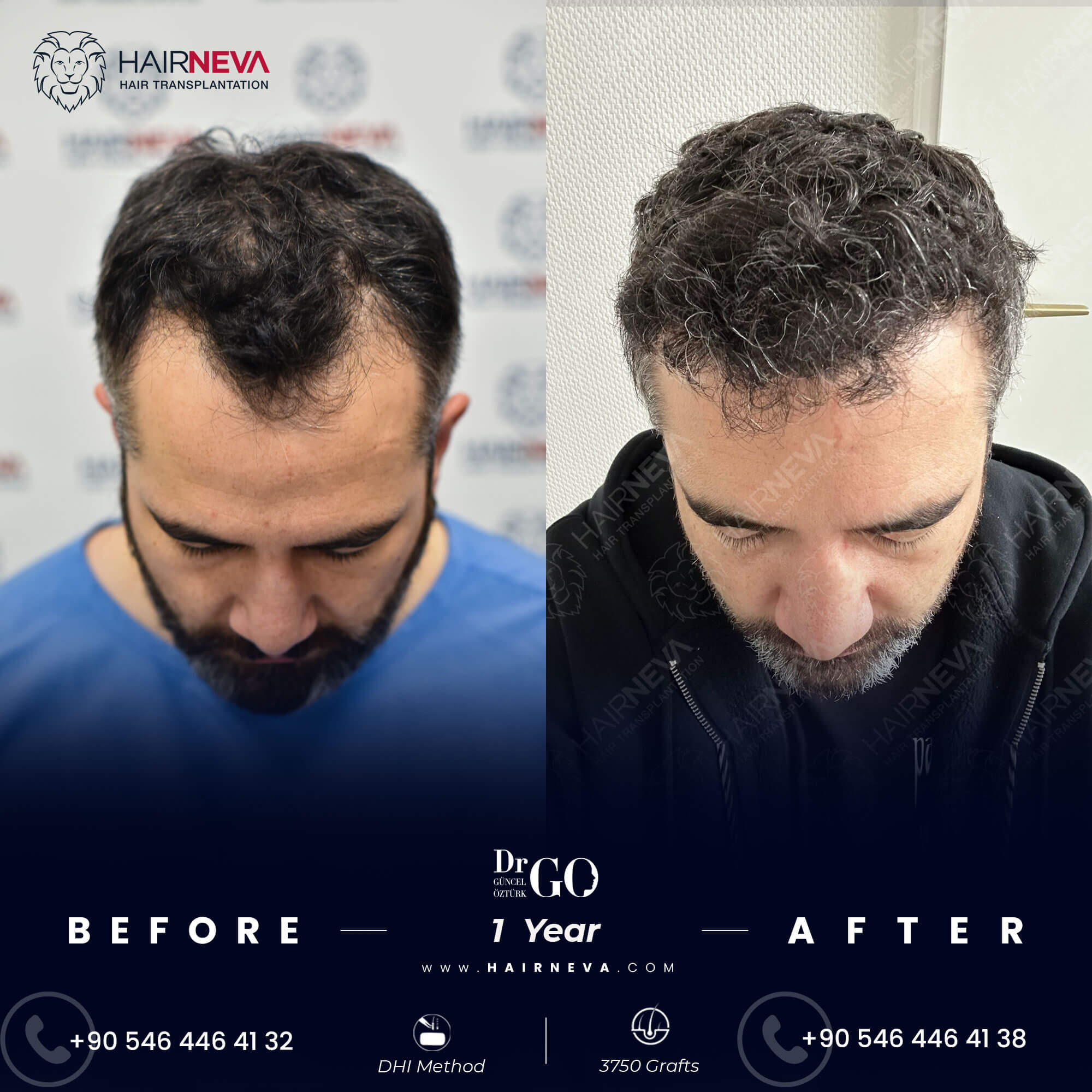 Before & After Hair Implantation