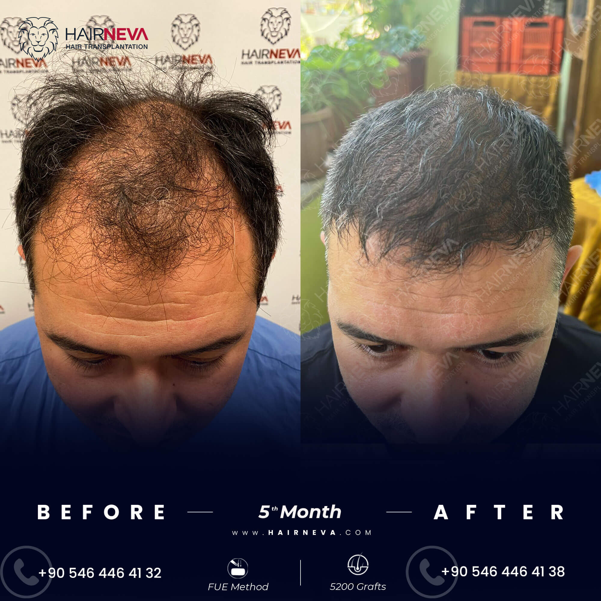 Before & After Hair Transplant