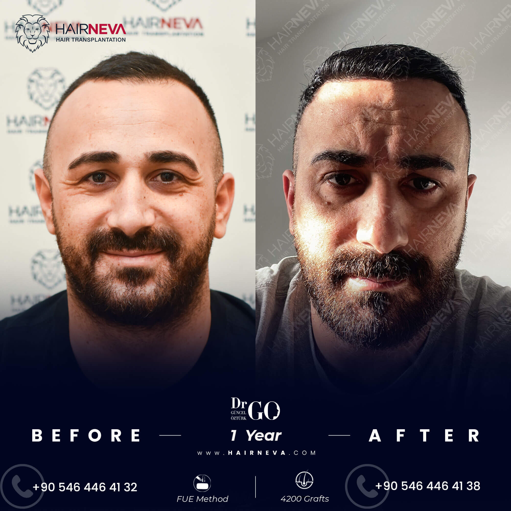 Hair Transplant Results