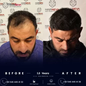 hair transplant hair transplant operations hair loss hair growth hair transplant surgery after hair transplant hair follicles hair transplant procedure