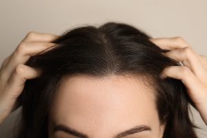 hair transplant in women