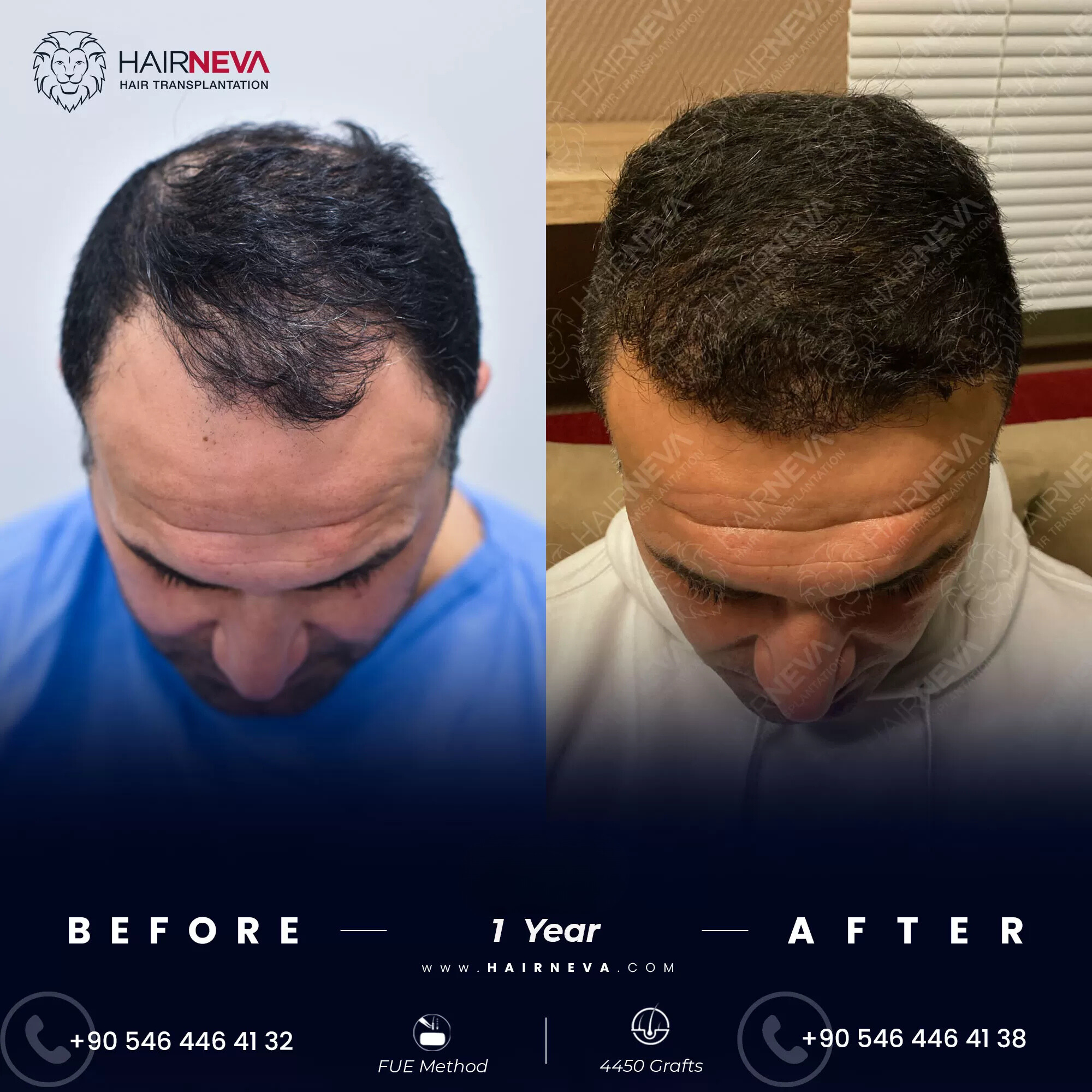 Cost Hair Transplant Before After