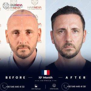 best place for hair transplant