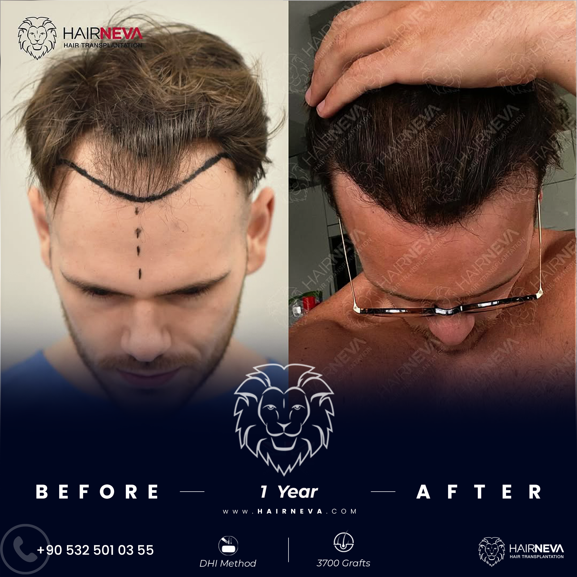 Hair Transplant in Turkey