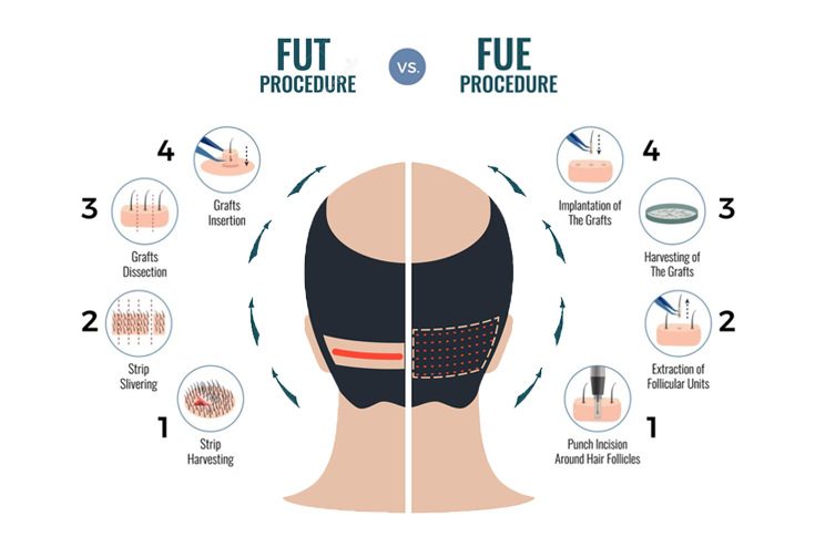 FUE vs. DHI Hair Transplant