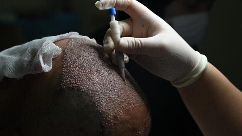 DHI Hair Transplant in Turkey