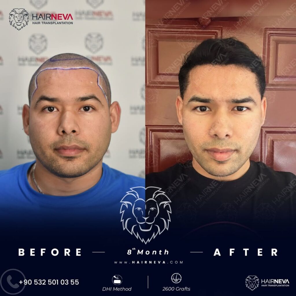 hair transplant in turkey