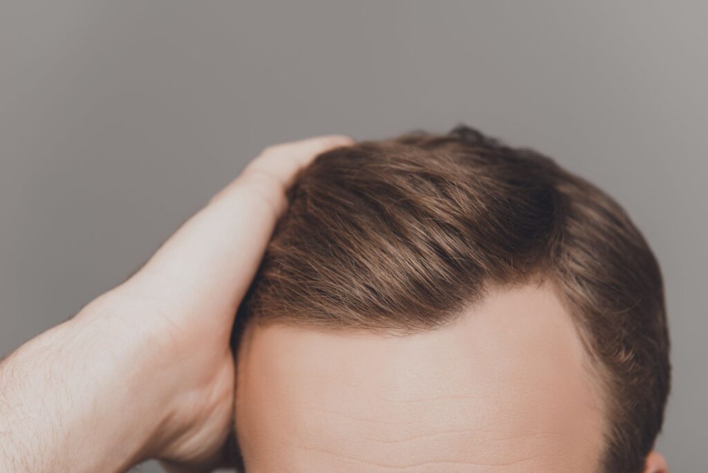 the unshaven hair transplant